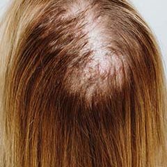Haarverdichtung Tritec ohne Schnitt vorher